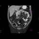 Sigmoid carcinoma, polyp of the ascending colon: CT - Computed tomography